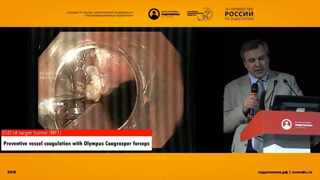 ЭНДОСКОПИЧЕСКАЯ ДИАГНОСТИКА И ЛЕЧЕНИЕ ДВУХ СИНХРОННЫХ ОПУХОЛЕЙ АБРИКОСОВА