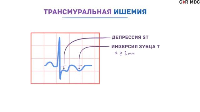 ЭКГ - инфаркт и ишемия