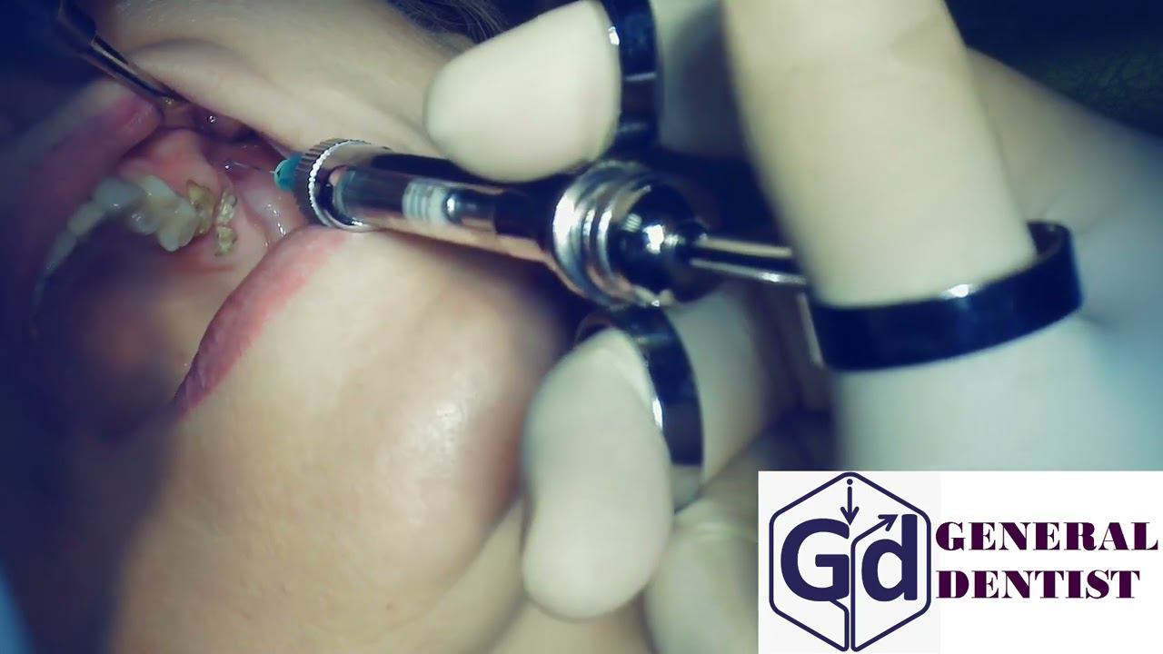 Infiltration anesthesia for extraction and one stage implantaton 26,27.