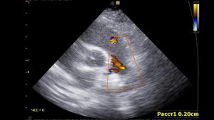 Коронарно-легочная фистула и ОАП