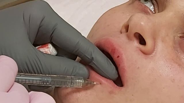 Заполнение губ филлером. Классическая линейная техника.