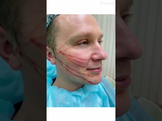 Подтяжка лица нитями АПТОС #skincare #beauty