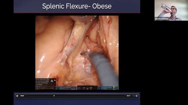 CRS Virtual Education: Mastering Splenic Flexure смотреть онлайн