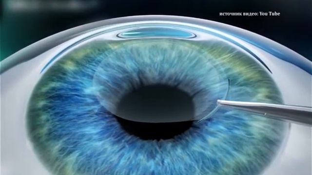 Прекрасное зрение за несколько минут - Новые технологии лазерной коррекции зрения смотреть онлайн