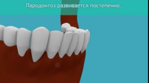 Пародонтоз Лечение пародонтоза в Китае