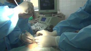 Пункция и дренирование под УЗ контролем при панкреонекрозе