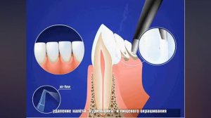 Этапы проведения профессиональной гигиены полости рта