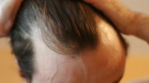 Как избавиться от залысин