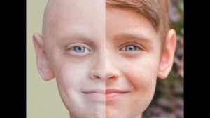 Лейкоз симптомы