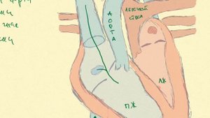 Полная транспозиция магистральных сосудов. Врожденные пороки сердца.