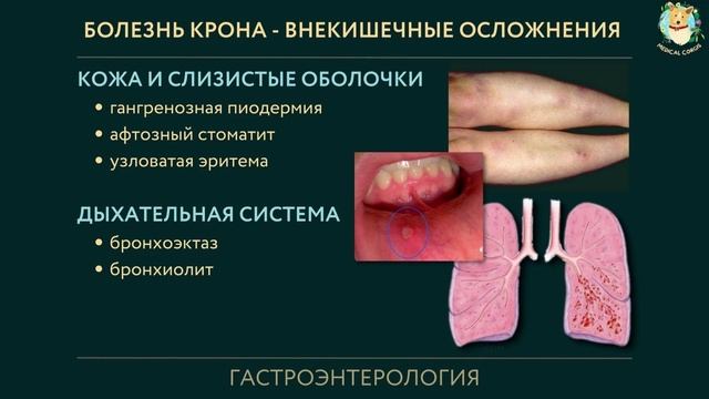Болезнь Крона за 20 минут