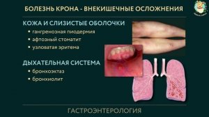 Болезнь Крона за 20 минут