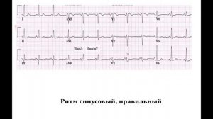 13:50  Методика расшифровки ЭКГ