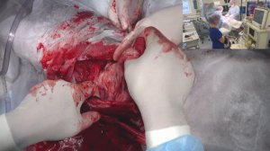 Удаление новообразования в брюшной полости
