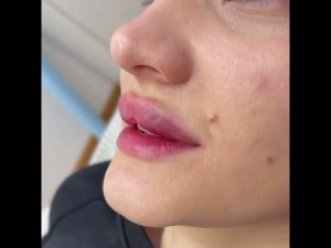 Аугментация губ_3
