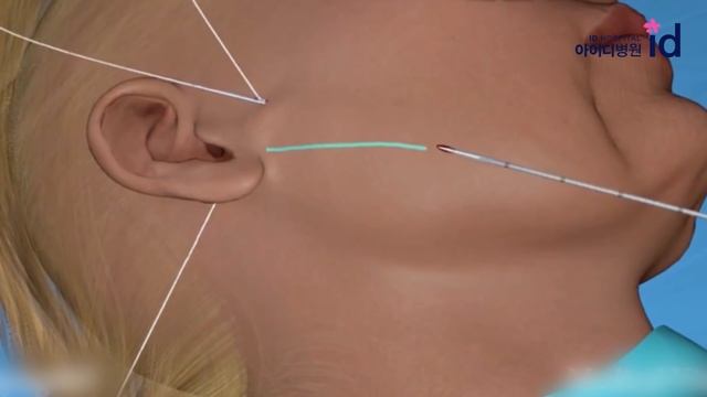 Safe and easy way to turn your age back! ID's Non-incisional SMAS lifting!! смотреть онлайн