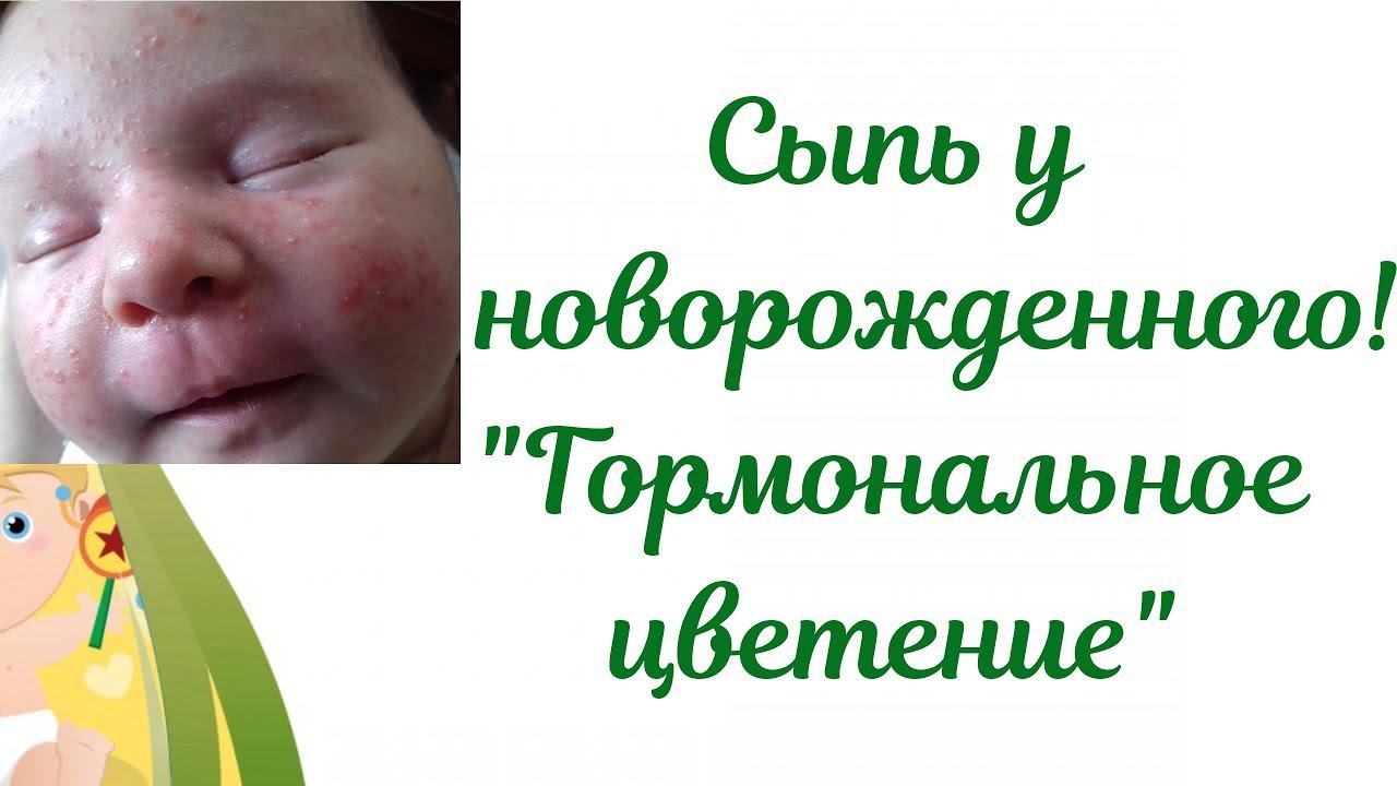 Акне новорожденных! Сыпь у новорожденного ребенка"Гормональное цветение"