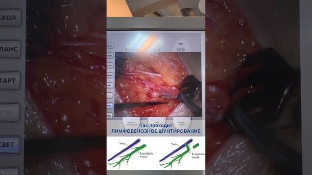Результаты лимфовенозного шунтирования правой верхней конечности у пациентки спустя 10 дней