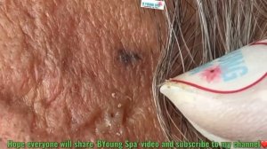 Get rid of blackheads 30 years in ears #226 | @B'Young Spa Quyet Hair 2