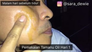 AMPUH ATASI BOPENG, BEKAS JERAWAT DAN KEMPESIN JERAWAT!!! BAHAN ALAMI TAPI SENYATA INI HASILNYA!!!