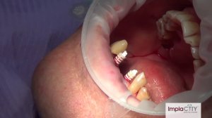 Одномоментная имплантация зубов. Немедленное протезирование зубов в стоматологии 'Импласити'