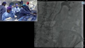 Transfemoral TAVR Evolut-Pro (26mm) and Sentinel Cerebral Protection - Structural Live July 2017