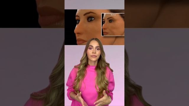 Как векторный лифтинг Radiesse борется с признаками старения смотреть онлайн