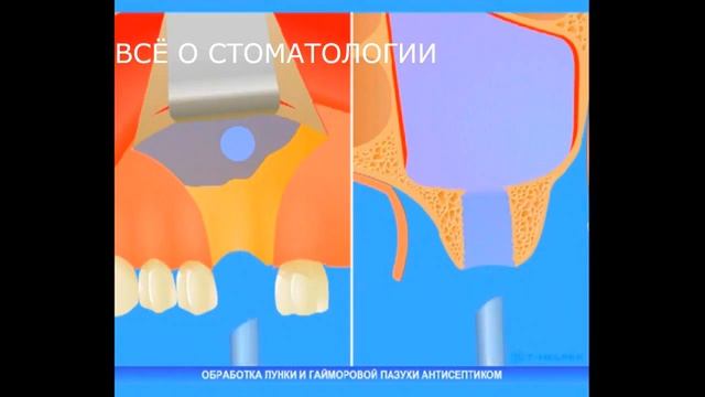 Свищ гайморовой пазухи