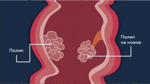 Лечение ПОЛИПОВ желудка народными средствами!