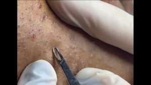 Удаление черных точек 2021 - Remoção de cravo 2021 - Pimple Popping 2021 -Blackhead Removal  EP004