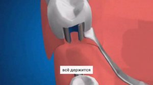 Протезы съемные и несъемные