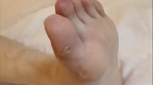 Ювенильная склеродермия (осмотр, без звука) © Juvenile Scleroderma (soundless)