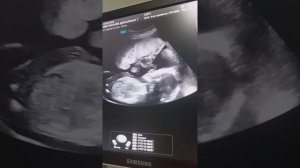 УЗИ 23 НЕДЕЛИ БЕРЕМЕННОСТИ/ Как на УЗИ видно пол малыша/ УЗИ ГЦРЧ  Натали Островская Игоревна/