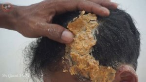 DANDRUFF SCRATCHING !!Big Scratching Dandruff Satisfying And Picking Psoriasis#310
