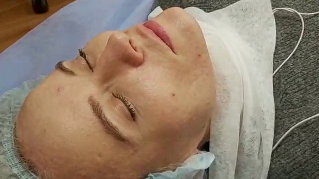 АирисКом студенты учатся: применение пилингов зимой,3х этапный метод,салициловая кислота,тса,ретино
