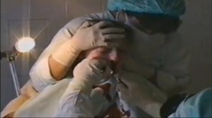 Классическая аденотомия под местной анестезией.mp4