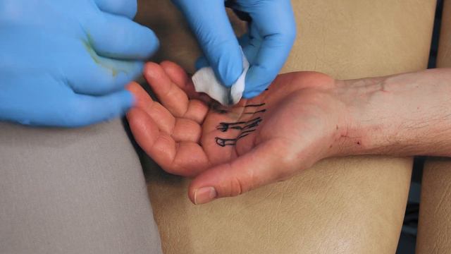 Стенозуючий теносиновіїт згиначів пальців. Тригерний палець Техніка введення MD Collagen смотреть онлайн