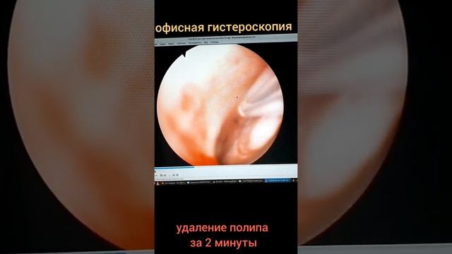 ОФИСНАЯ ГИСТЕРОСКОПИЯ. УДАЛЕНИЕ ПОЛИПА МАТКИ ЗА 2 МИНУТЫ.