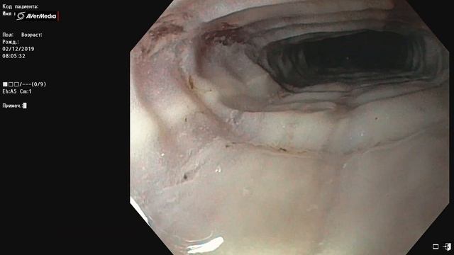 Выраженный эзофагит на фоне фиксированный ГПОД смотреть онлайн