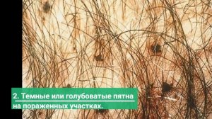 Как Обнаружить Лобковых Вшей