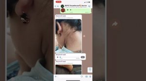 Контагиозный моллюск 👆 ELEV8