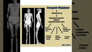 Синдром Марфана. Что надо знать родителям очень гибких детей.