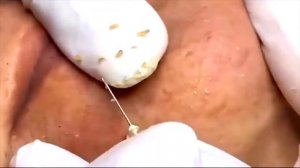 лучшее удаление прыщей#32