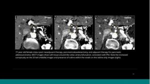 Introduction to Dual Energy CT Dr. Bhavik Patel