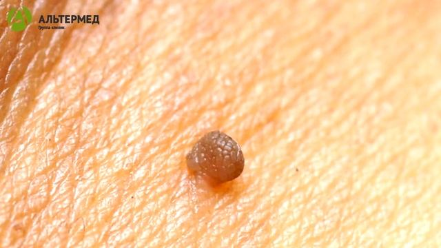 Кондиломы шейки матки смотреть онлайн