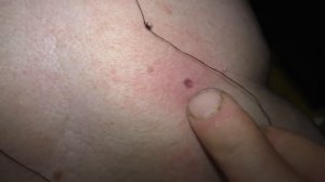 ЖЕСТЬ!!! ВПИЛСЯ КЛЕЩ В БАБУШКУ!!! ВЫТАЩИЛ ОЧЕНЬ ПРОСТО И ЛЕГКО! Проверенный способ.