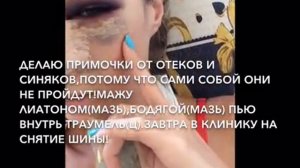 Первый день после ринопластики;)Пошаговая Реабилитация После Ринопластики!