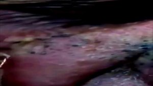 лучшее удаление черных точек#27