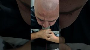 Хиджама на лоб, кровопускание