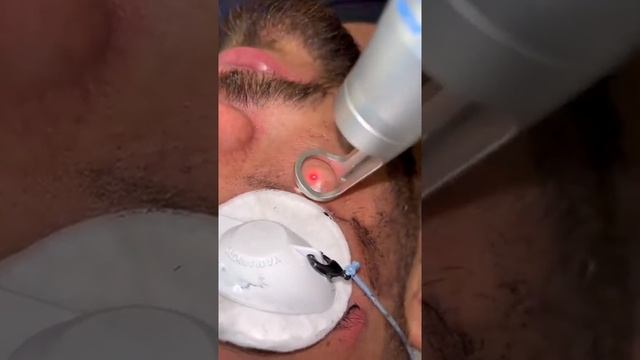 Facial laser